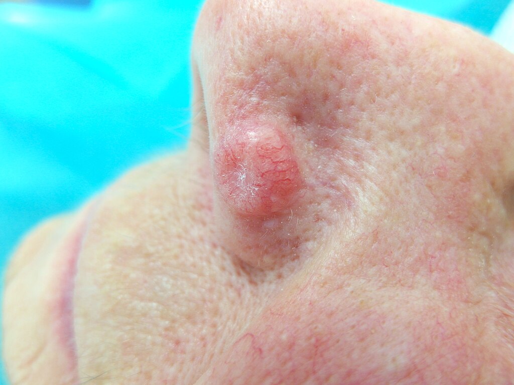 Basal Cell Carcinoma