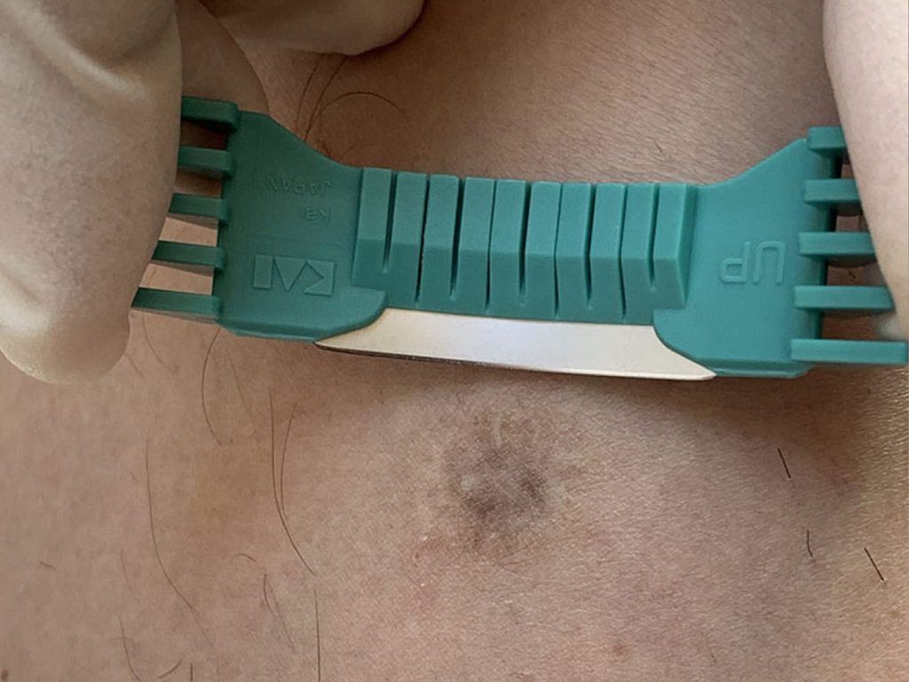 Scrape Biopsy