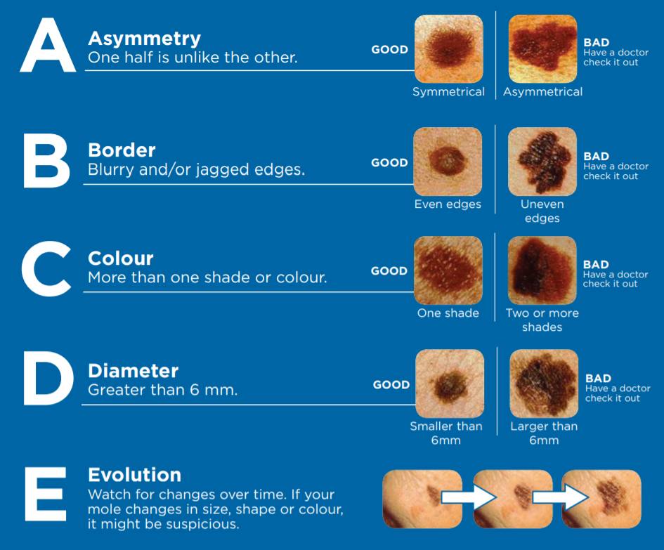 Skin cancer identifier chart