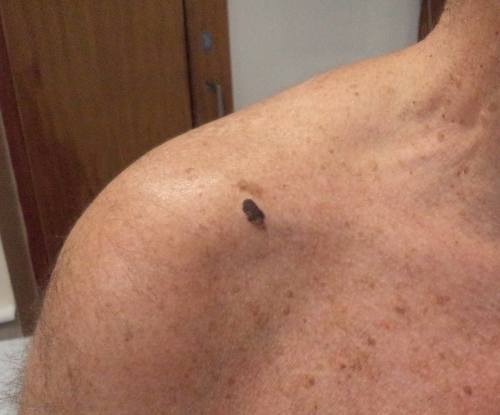 Mole changes