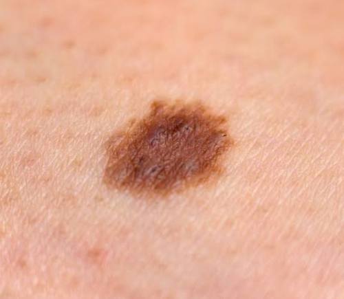 Could this spot be skin cancer