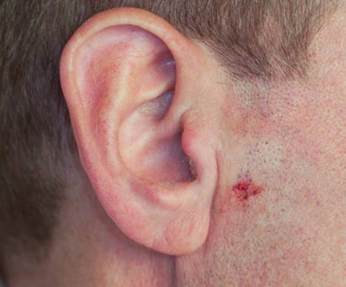 Skin cancer spot not healing