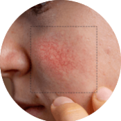 Laser Vein Treatment
