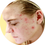 facial spots 175px