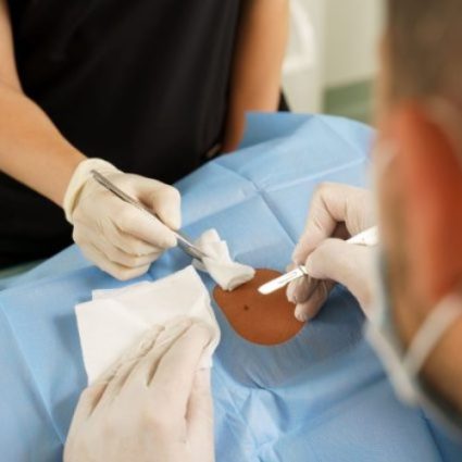 mole removal