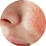 rosacea treatments