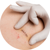 Scar Treatment