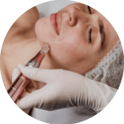 Skin Needling